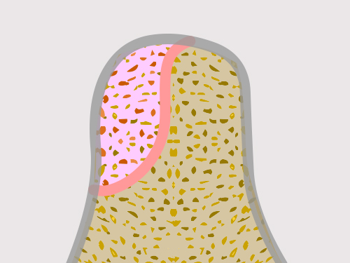 식립 할 위치에 인공뼈 이식