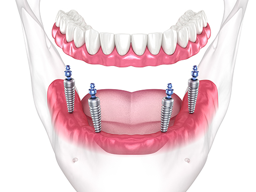 임플란트 틀니 고정