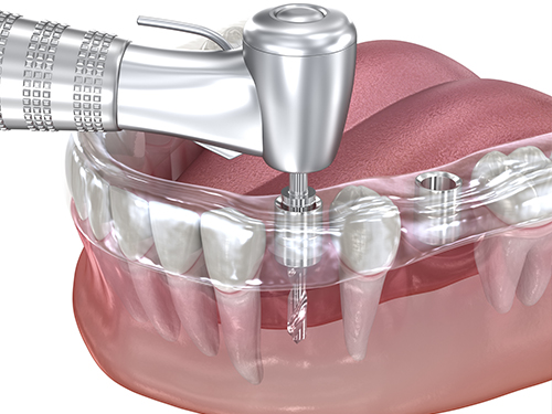 3D 디지털 임플란트 시행