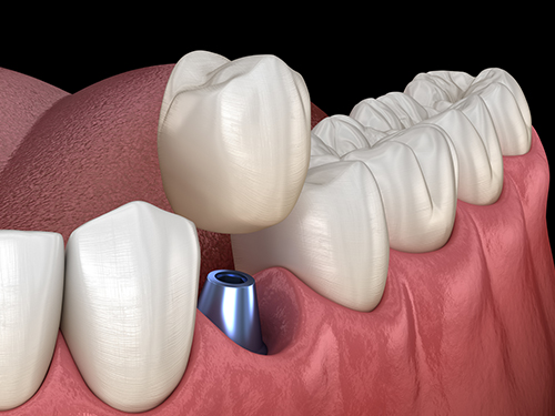 최종 보철물 장착
