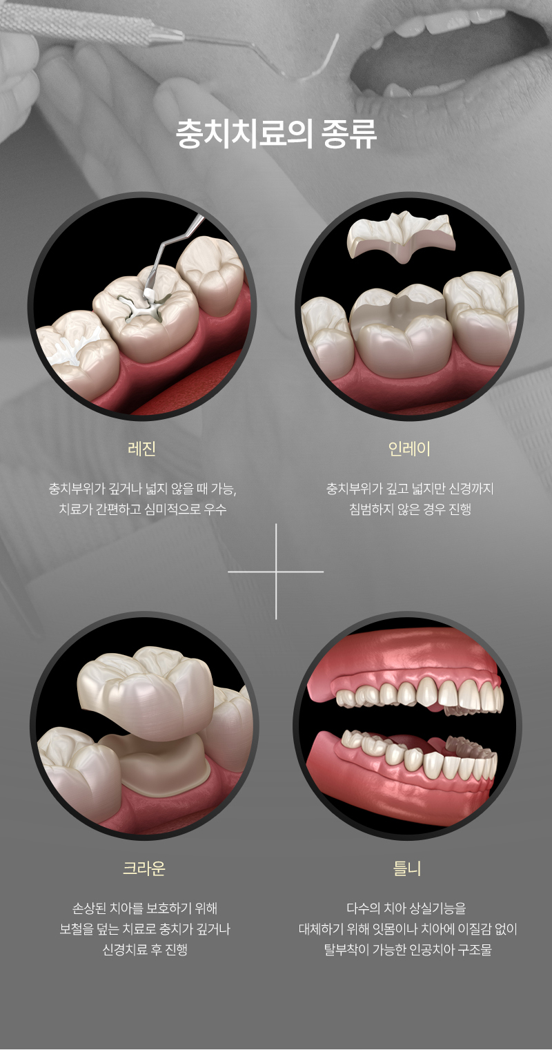충치치료